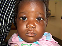 A baby following treatment