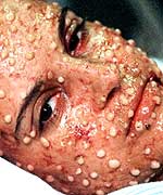 Woman with smallpox