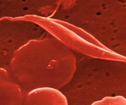 Sickle Cell