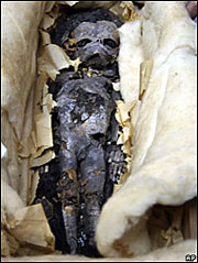 Mummified foetus 