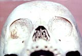 A child's skull, showing anaemic lesions in the eye sockets