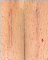 Scars