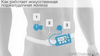 Pancreas infographic