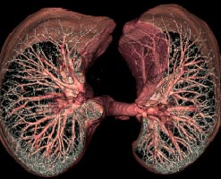An EBCT scan of the lungs