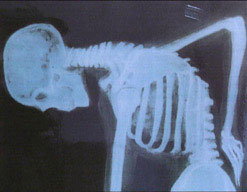 X-ray showing curvature of the spine