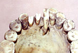 The worn teeth of an ancient Egyptian showing an abscess drainage hole